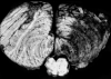 Right posterior inferior cerebellar artery infarct, with hemorrhagic transformation